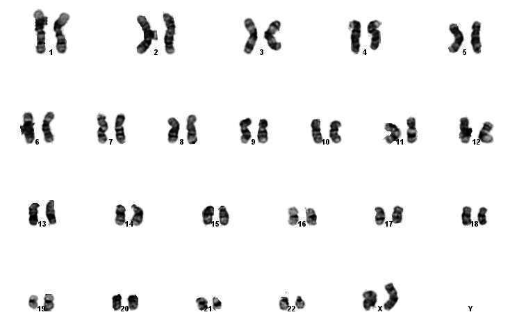 Conventional cytogenetics showing normal karyotype: 46,XX